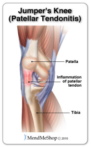 Patellar tendonitis or Jumpers knee