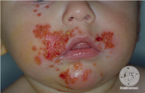 A child's face affected by infantigo skin disease