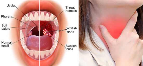 tonsils-stone-prevention
