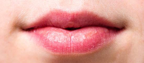 Dry, cracked and itchy female lips